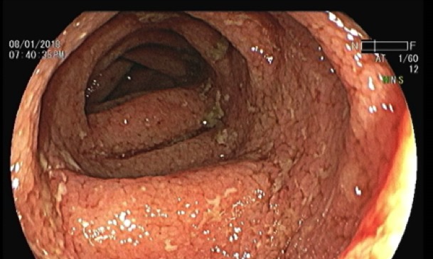 Gastroenterólogos convocan a pacientes con enfermedades inflamatorias intestinales a vacunarse contra Covid e Influenza