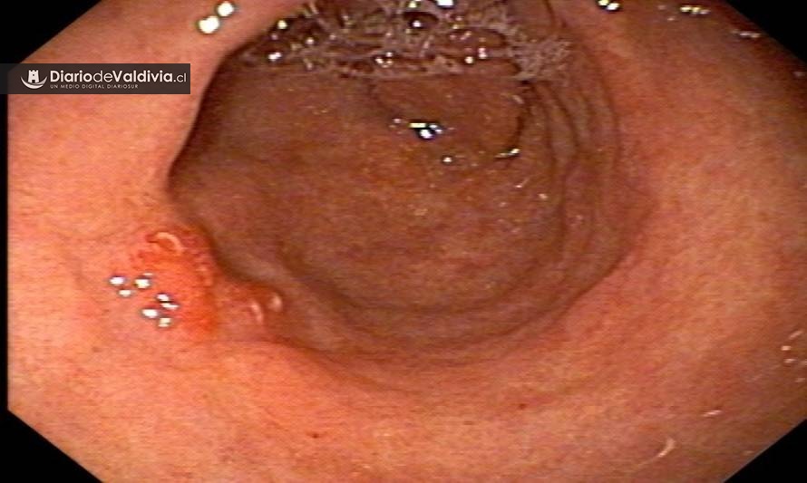 Día Mundial del Estómago: Cada año mueren 3 mil personas a causa del cáncer gástrico en Chile